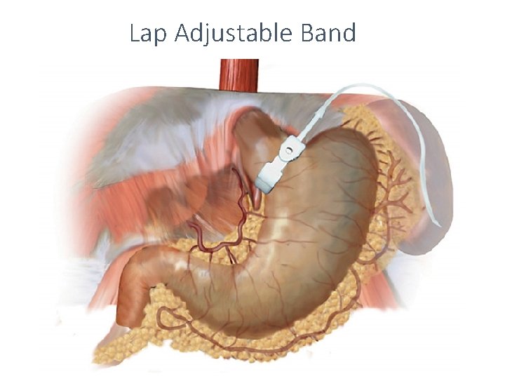 Lap Adjustable Band 