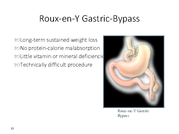 Roux-en-Y Gastric-Bypass Long-term sustained weight loss No protein-calorie malabsorption Little vitamin or mineral deficiencies