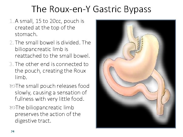 The Roux-en-Y Gastric Bypass 1. A small, 15 to 20 cc, pouch is created