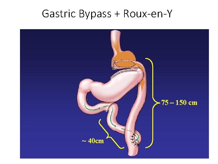 Gastric Bypass + Roux-en-Y 75 – 150 cm ~ 40 cm 