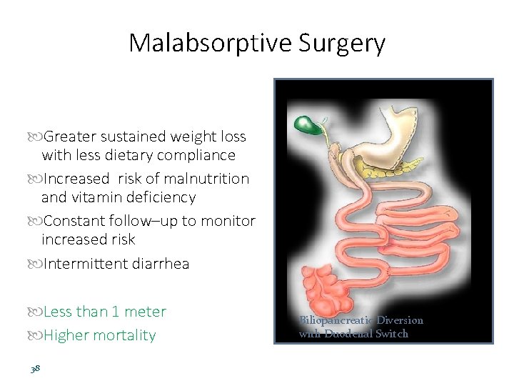 Malabsorptive Surgery Greater sustained weight loss with less dietary compliance Increased risk of malnutrition