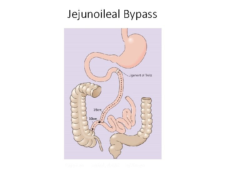 Jejunoileal Bypass Payne and Dewind, Archives of Surgery, 1973 