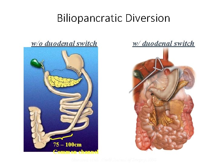 Biliopancratic Diversion w/o duodenal switch w/ duodenal switch 75 – 100 cm Common channel