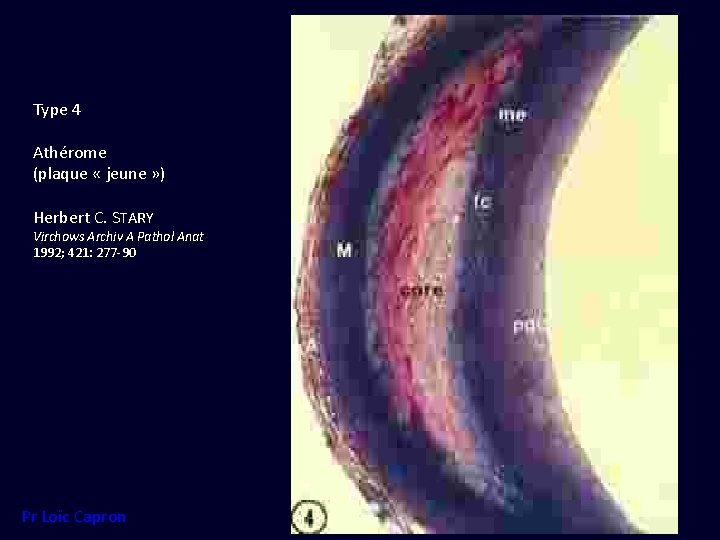 Type 4 Athérome (plaque « jeune » ) Herbert C. STARY Virchows Archiv A