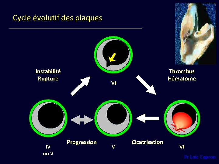 Cycle évolutif des plaques Instabilité Rupture IV ou V Thrombus Hématome VI Progression V
