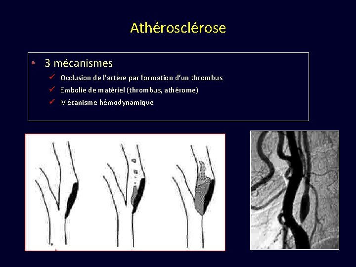Athérosclérose • 3 mécanismes ü Occlusion de l’artère par formation d’un thrombus ü Embolie