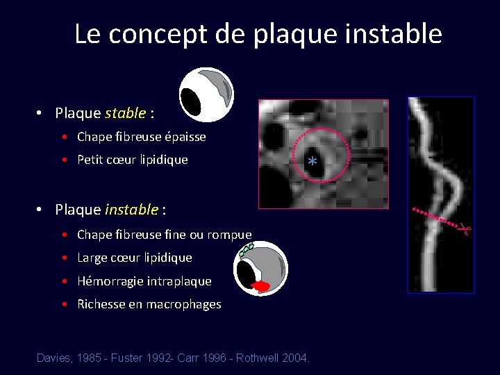 Le concept de plaque instable • Plaque stable : • Chape fibreuse épaisse •