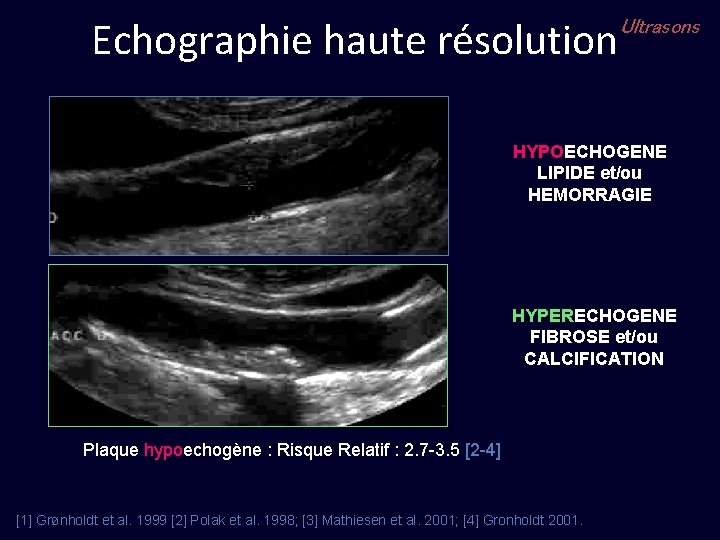 Echographie haute résolution Ultrasons HYPOECHOGENE LIPIDE et/ou HEMORRAGIE HYPERECHOGENE FIBROSE et/ou CALCIFICATION Plaque hypoechogène