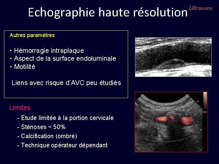 Echographie haute résolution Autres paramètres • Hémorragie intraplaque • Aspect de la surface endoluminale