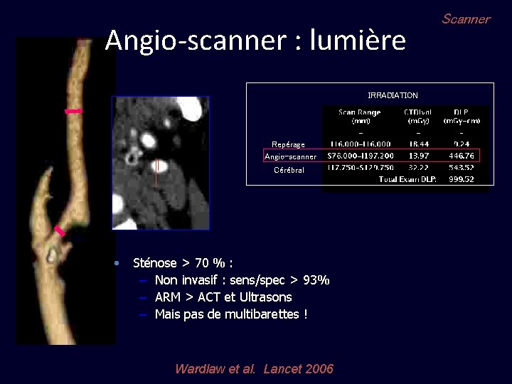 Angio-scanner : lumière IRRADIATION Repérage Angio-scanner Cérébral • Sténose > 70 % : –