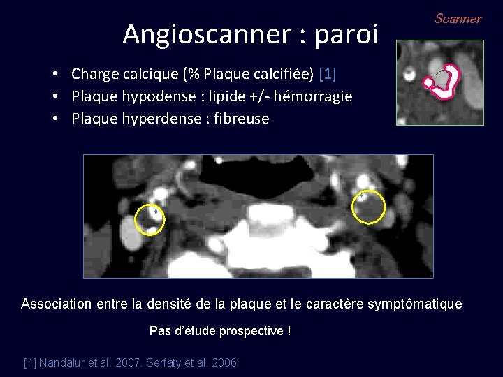 Angioscanner : paroi Scanner • Charge calcique (% Plaque calcifiée) [1] • Plaque hypodense