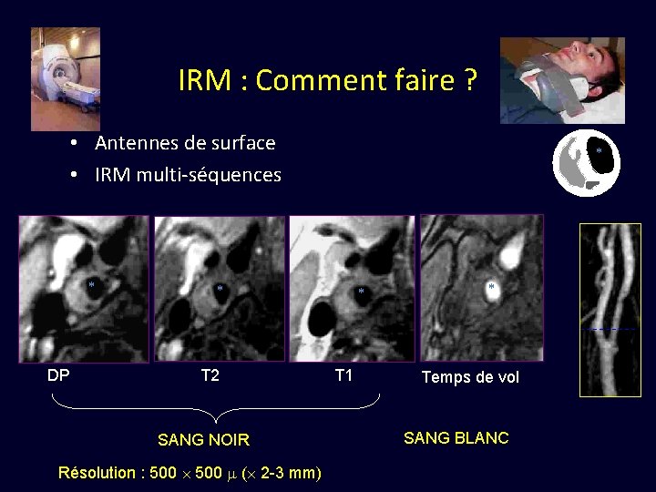 IRM : Comment faire ? • Antennes de surface • IRM multi-séquences * DP