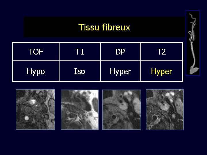 Tissu fibreux TOF T 1 DP T 2 Hypo Iso Hyper 