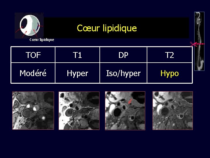 Cœur lipidique TOF T 1 DP T 2 Modéré Hyper Iso/hyper Hypo 