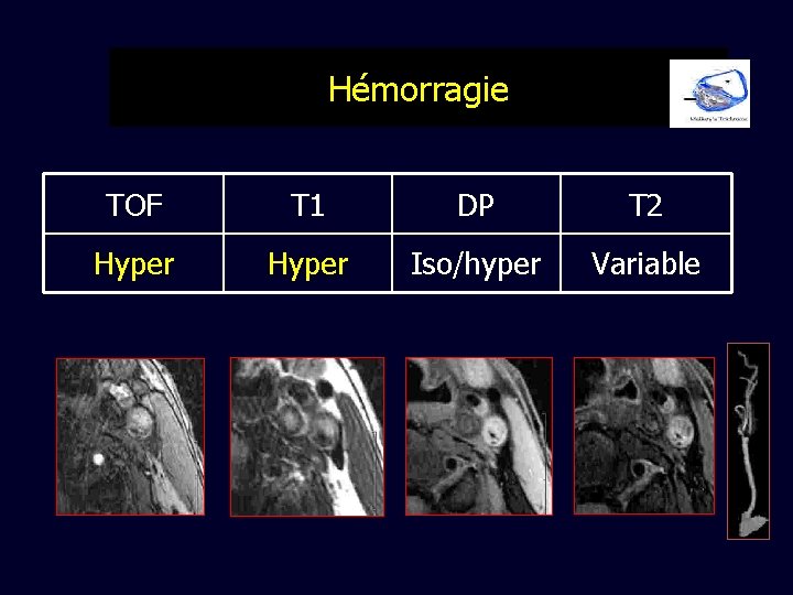 Hémorragie TOF T 1 DP T 2 Hyper Iso/hyper Variable 