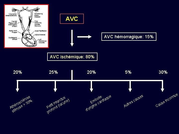 AVC hémorragique: 15% AVC ischémique: 80% 20% e ros é l sc 50% o