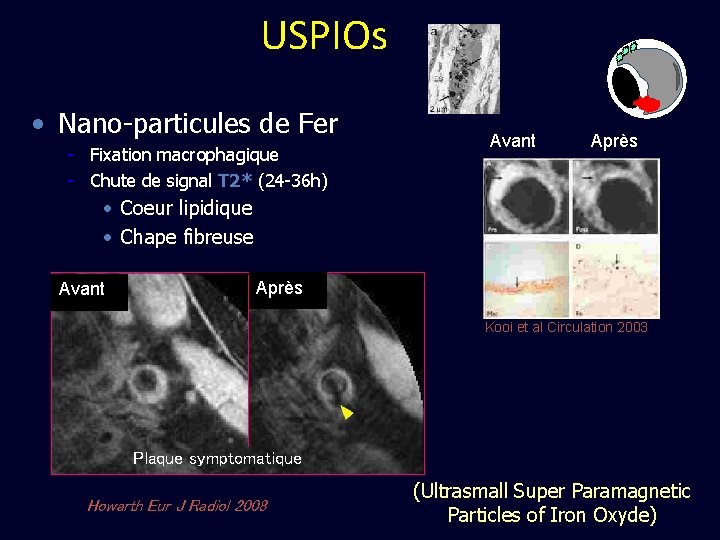 USPIOs • Nano-particules de Fer - Fixation macrophagique - Chute de signal T 2*