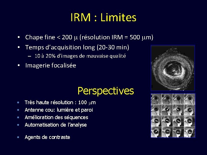 IRM : Limites • Chape fine < 200 (résolution IRM = 500 m) •