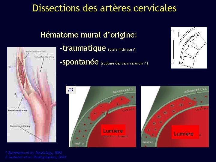 Dissections des artères cervicales Hématome mural d’origine: -traumatique -spontanée (plaie intimale ? ) (rupture