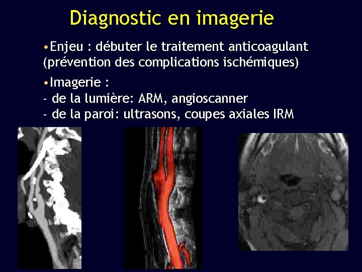 Diagnostic en imagerie • Enjeu : débuter le traitement anticoagulant (prévention des complications ischémiques)