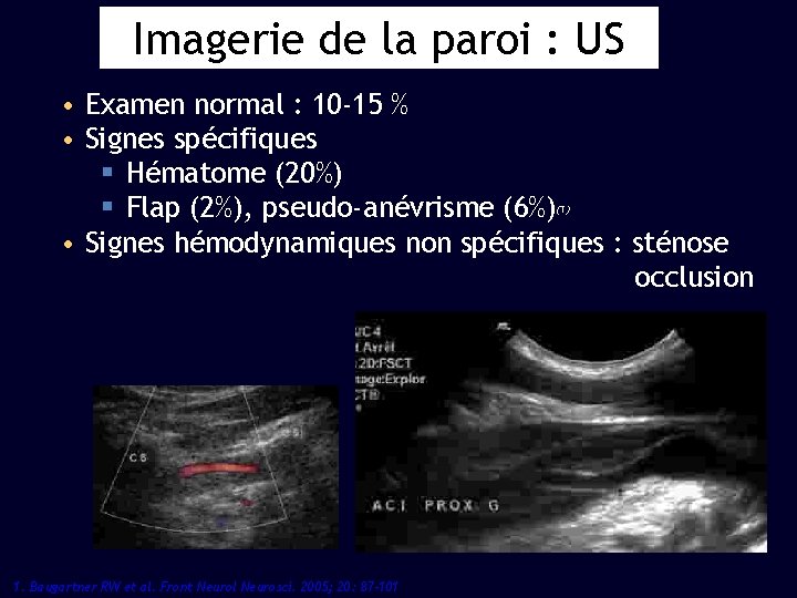 Imagerie de la paroi : US • Examen normal : 10 -15 % •