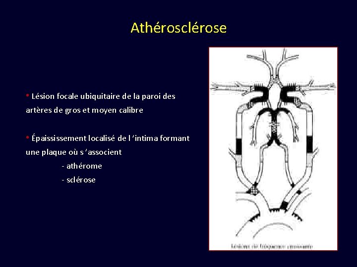 Athérosclérose • Lésion focale ubiquitaire de la paroi des artères de gros et moyen