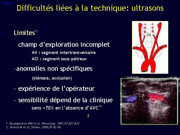 Pièges Difficultés liées à la technique: ultrasons Limites : (1) - champ d’exploration incomplet