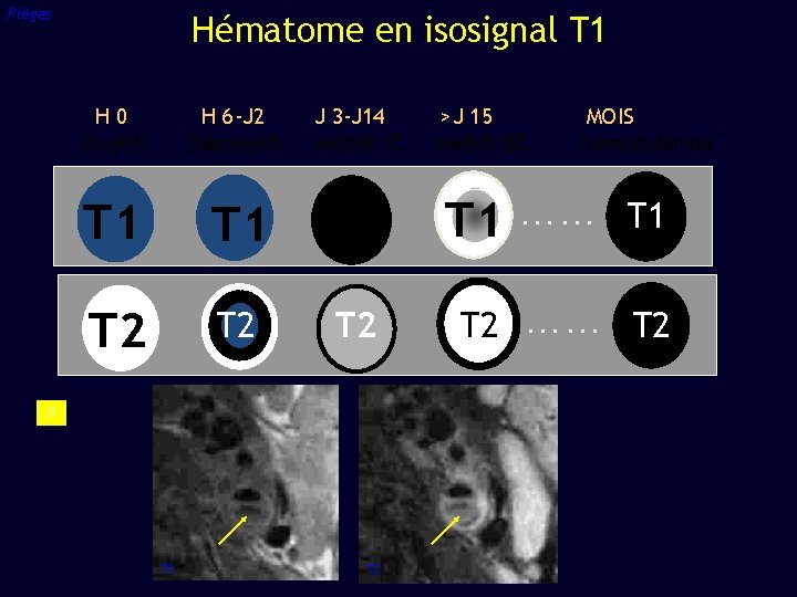 Pièges Hématome en isosignal T 1 H 0 Oxy. Hb H 6 -J 2