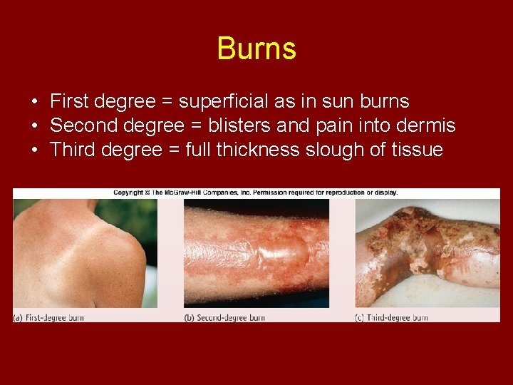 Burns • First degree = superficial as in sun burns • Second degree =