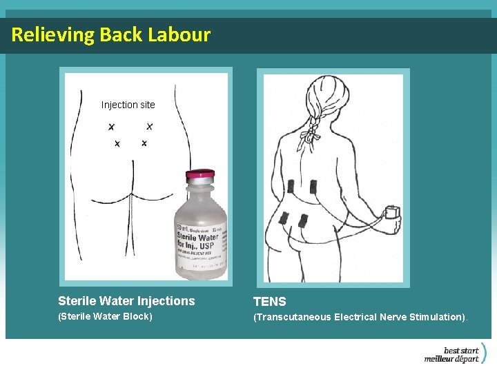 Relieving Back Labour Injection site Sterile Water Injections TENS (Sterile Water Block) (Transcutaneous Electrical