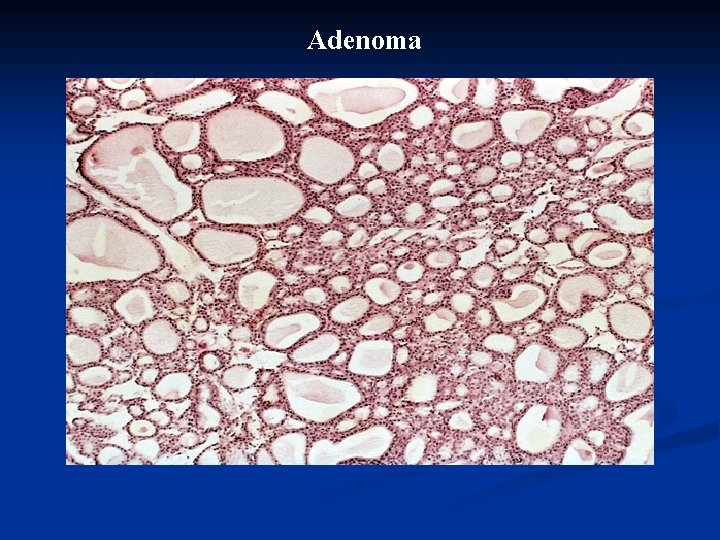 Adenoma 