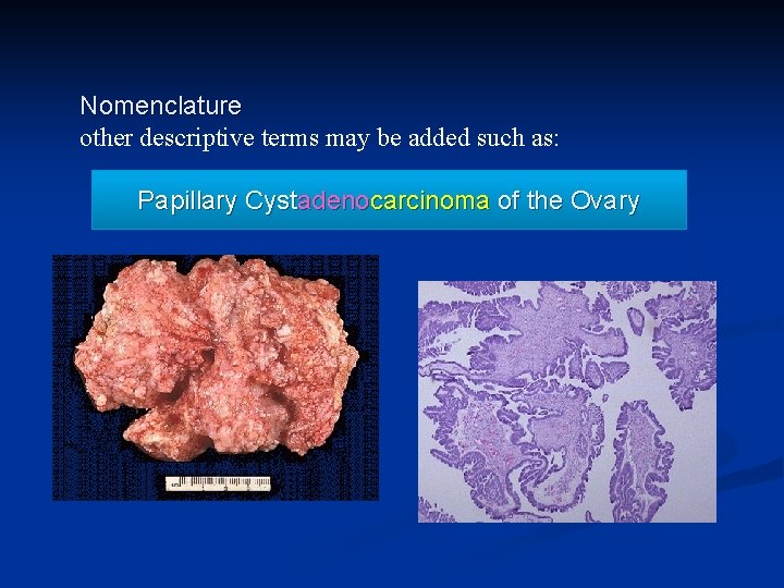 Nomenclature other descriptive terms may be added such as: Papillary Cystadenocarcinoma of the Ovary