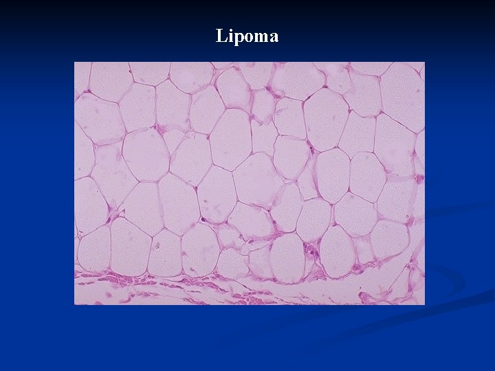 Lipoma 