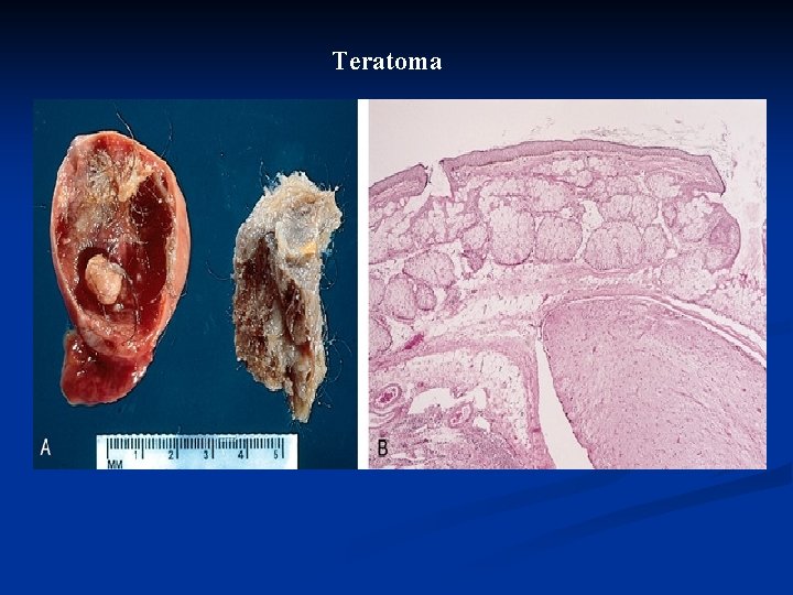 Teratoma 