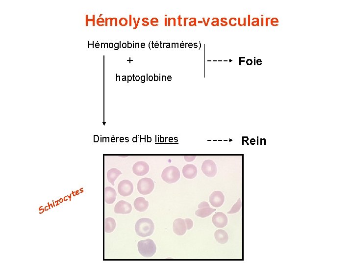 Hémolyse intra-vasculaire Hémoglobine (tétramères) + Foie haptoglobine Dimères d’Hb libres z hi c S