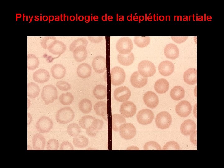 Physiopathologie de la déplétion martiale 