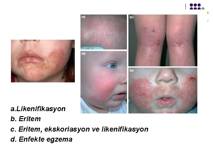 a. Likenifikasyon b. Eritem c. Eritem, ekskoriasyon ve likenifikasyon d. Enfekte egzema 