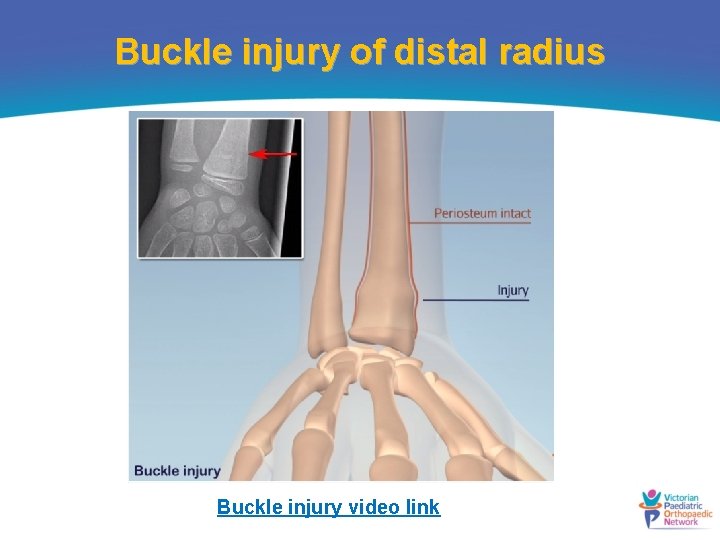 Buckle injury of distal radius Buckle injury video link 