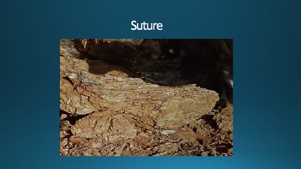 Suture 