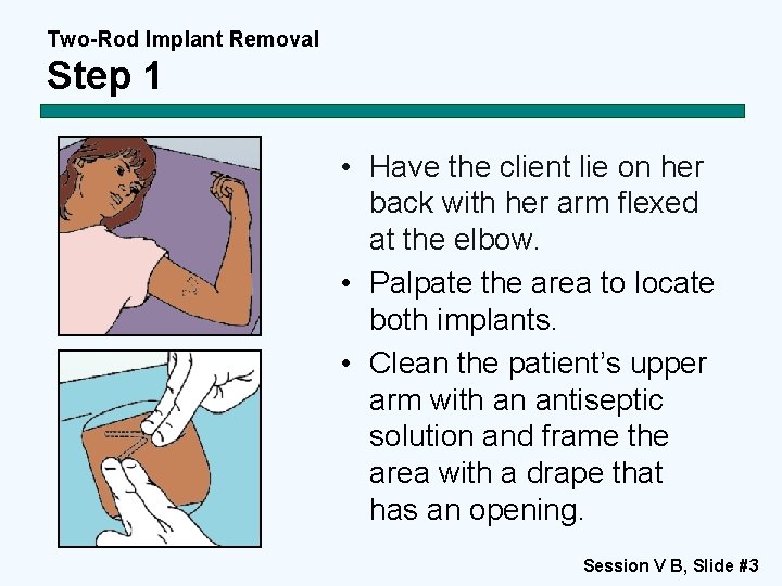 Two-Rod Implant Removal Step 1 • Have the client lie on her back with