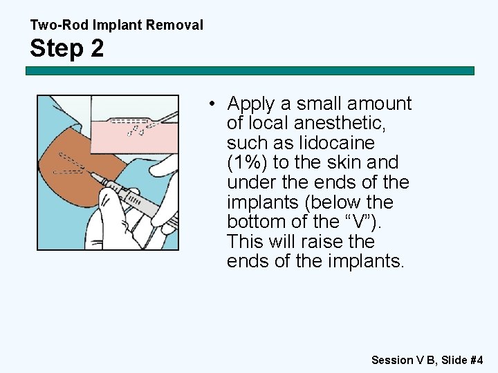Two-Rod Implant Removal Step 2 • Apply a small amount of local anesthetic, such