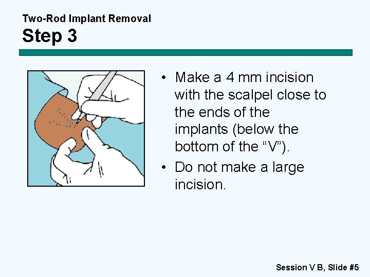 Two-Rod Implant Removal Step 3 • Make a 4 mm incision with the scalpel