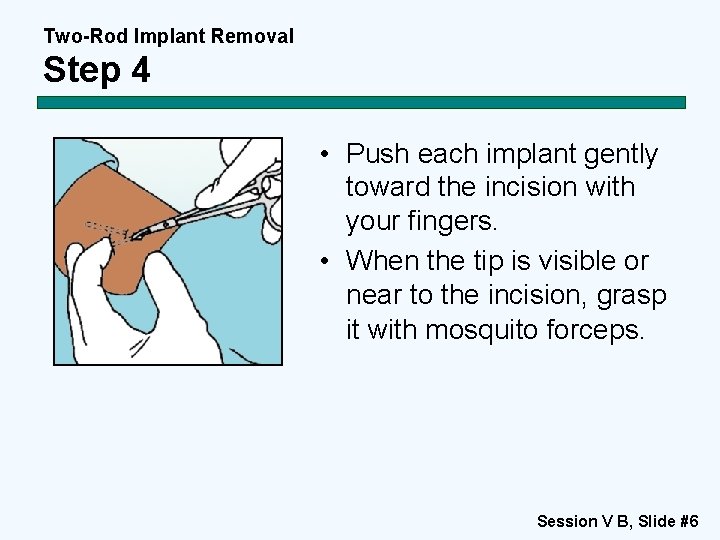 Two-Rod Implant Removal Step 4 • Push each implant gently toward the incision with