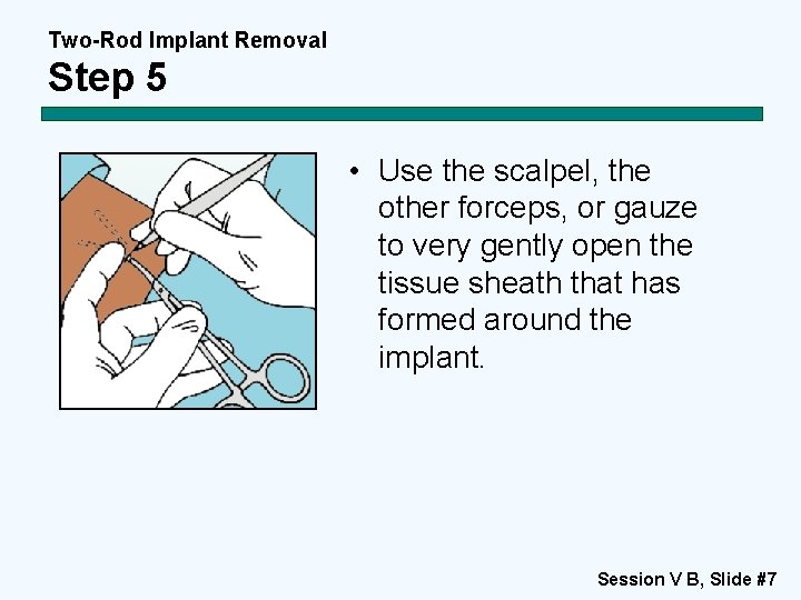 Two-Rod Implant Removal Step 5 • Use the scalpel, the other forceps, or gauze