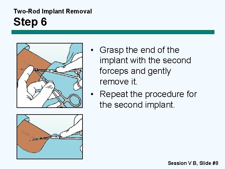 Two-Rod Implant Removal Step 6 • Grasp the end of the implant with the