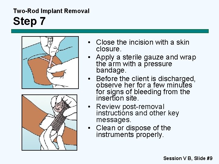 Two-Rod Implant Removal Step 7 • Close the incision with a skin closure. •
