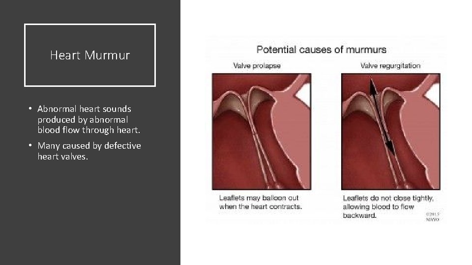Heart Murmur • Abnormal heart sounds produced by abnormal blood flow through heart. •