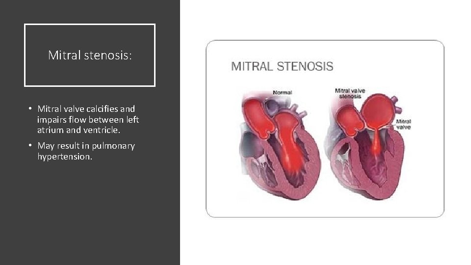 Mitral stenosis: • Mitral valve calcifies and impairs flow between left atrium and ventricle.