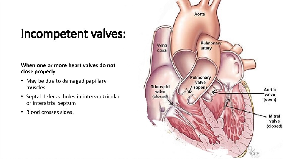 Incompetent valves: When one or more heart valves do not close properly • May