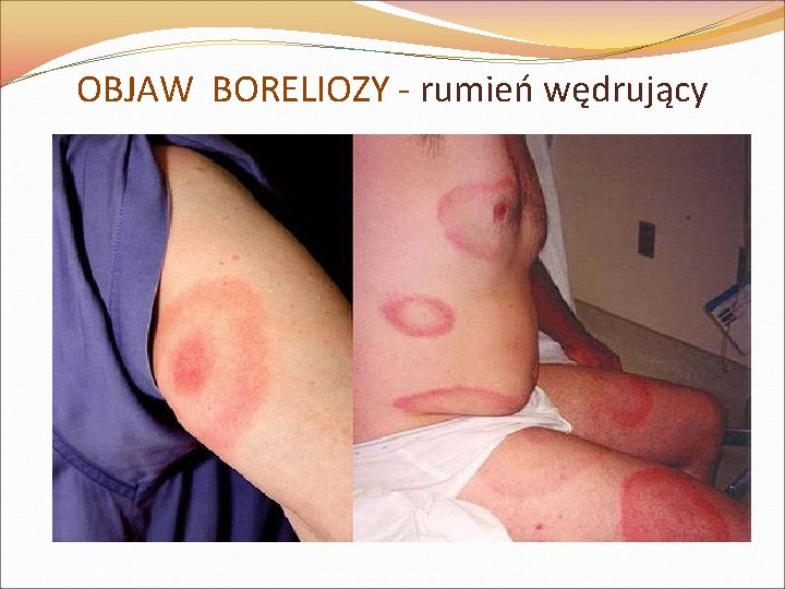 OBJAW BORELIOZY - rumień wędrujący 
